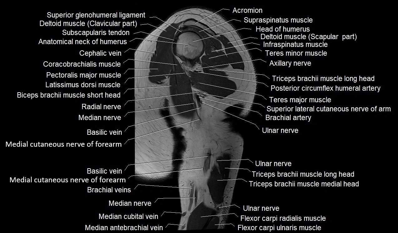 Upper arm (humerus ) saittal cross sectional anatomy 3T image 23.webp